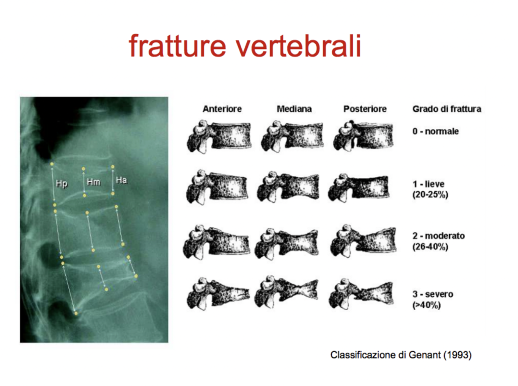fratture vertebrali