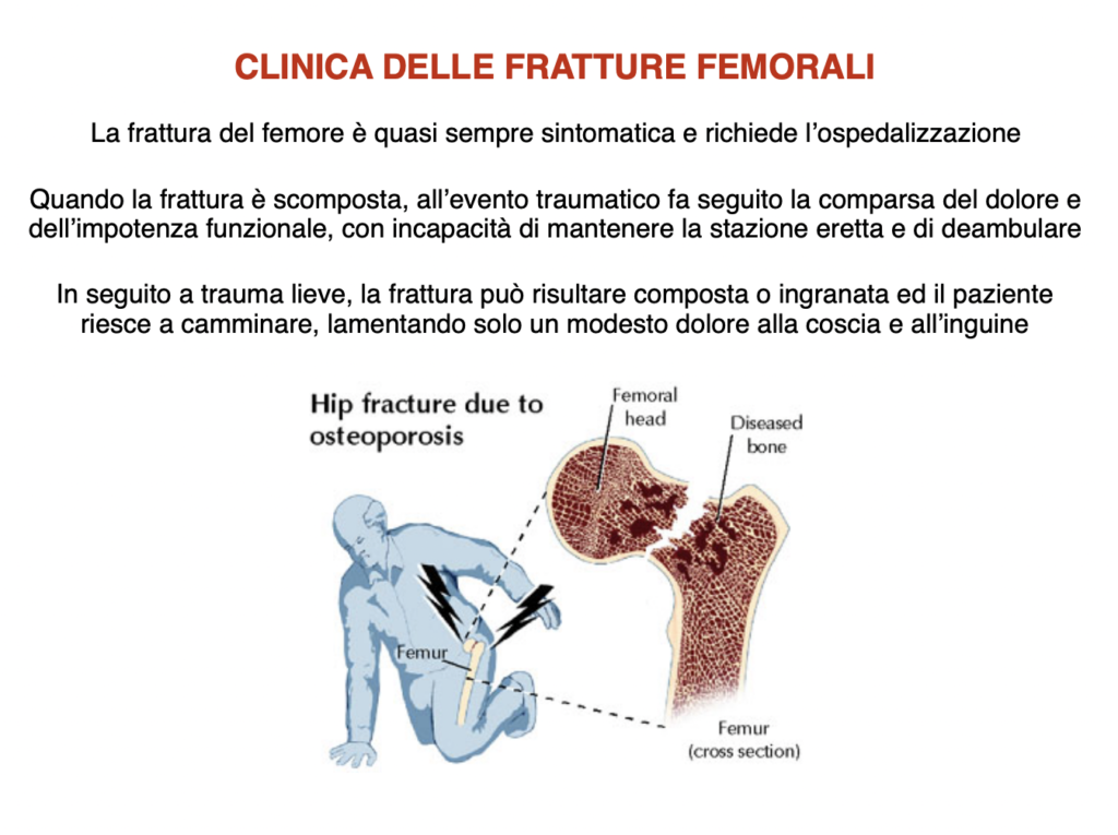 clinica delle fratture femorali